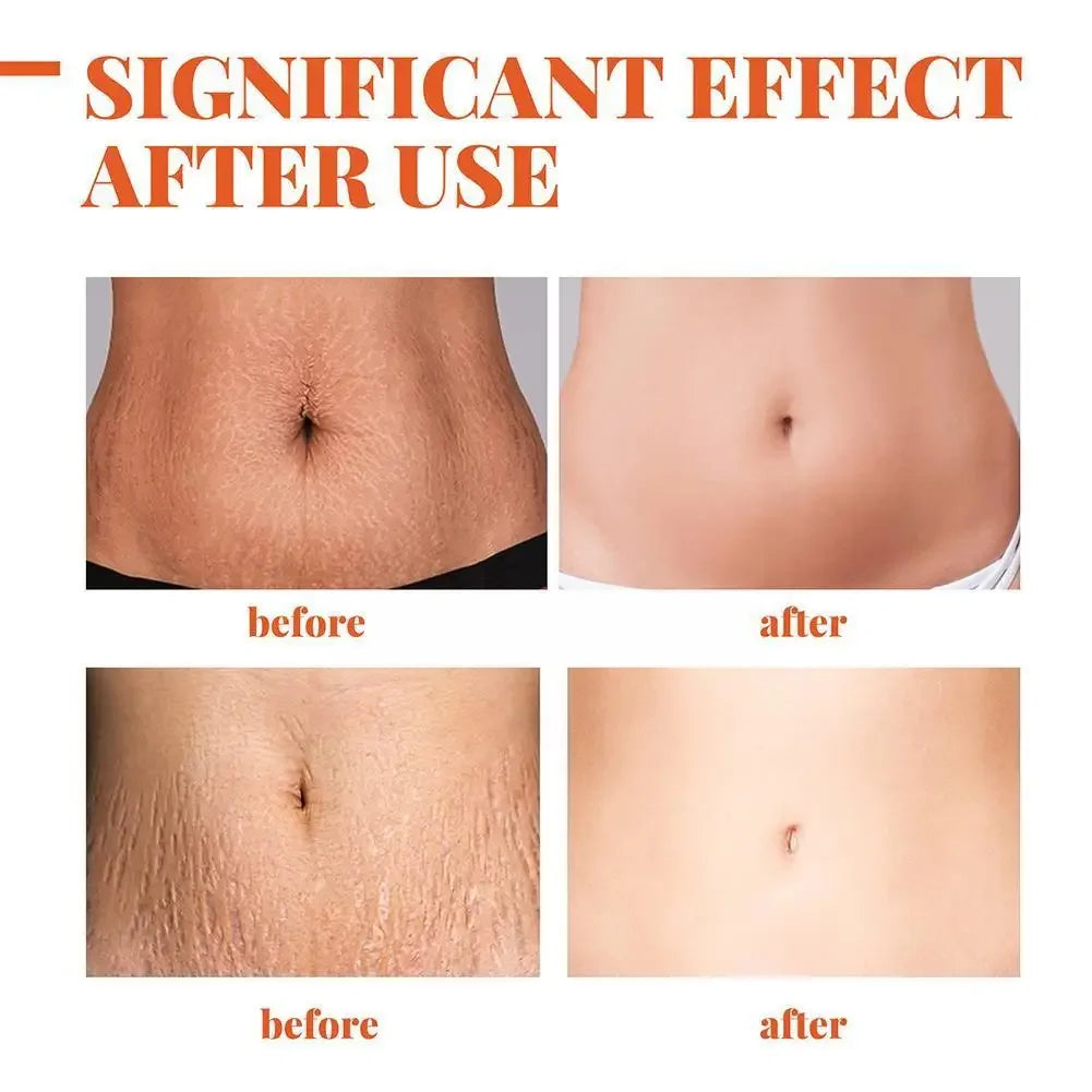 Stretch Marks Removal Cream – Anti-Aging & Skin Firming Body Treatment