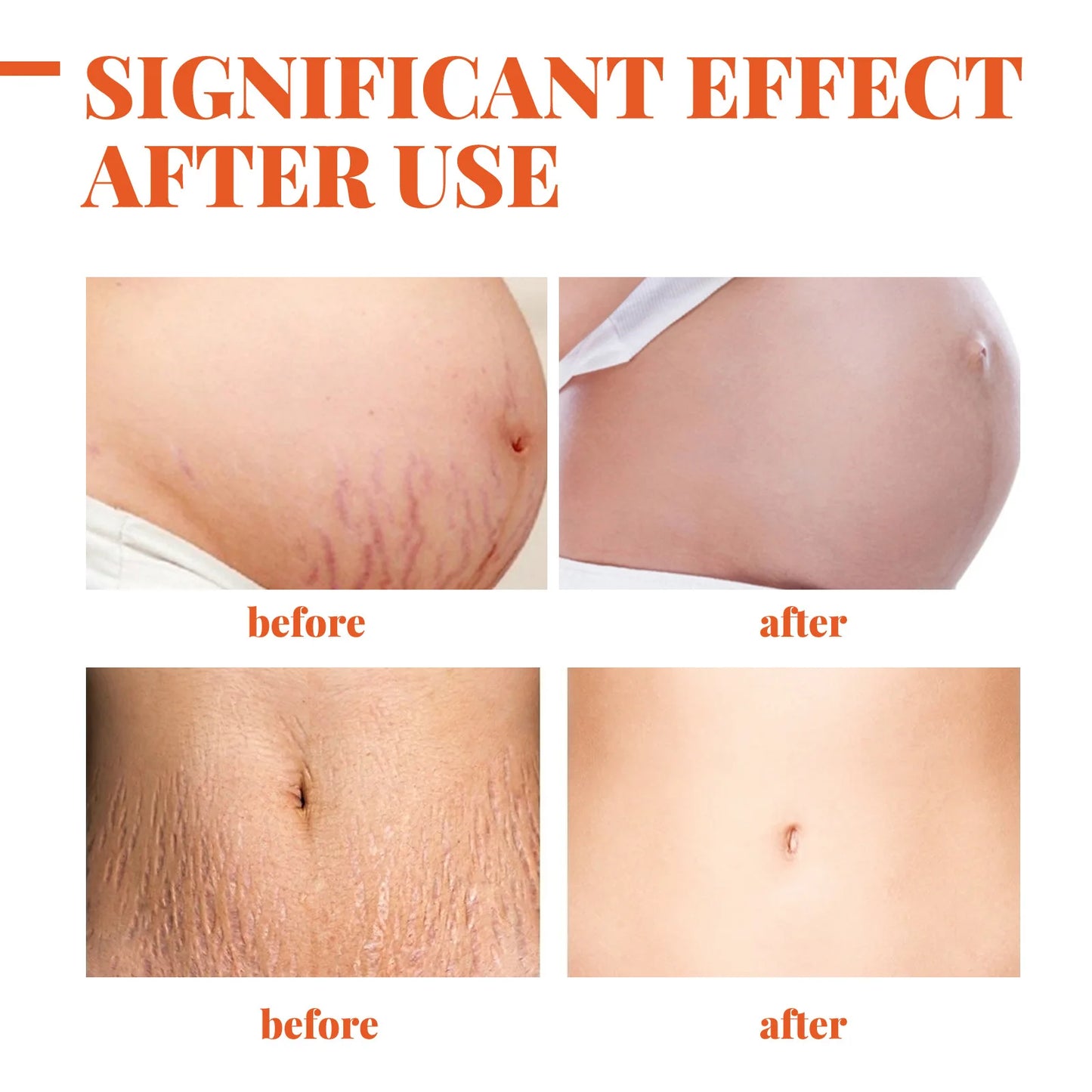Stretch Marks Removal Cream – Anti-Aging & Skin Firming Body Treatment