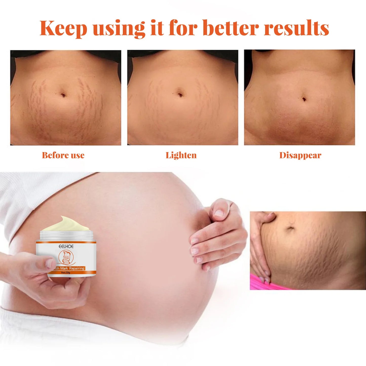 Stretch Marks Removal Cream – Anti-Aging & Skin Firming Body Treatment