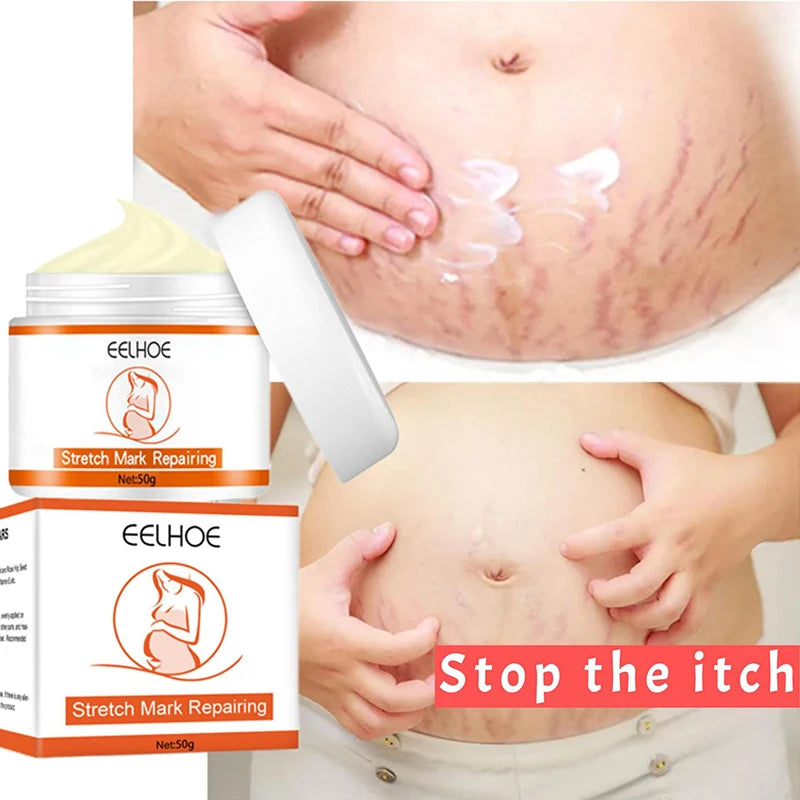 Stretch Marks Removal Cream – Anti-Aging & Skin Firming Body Treatment