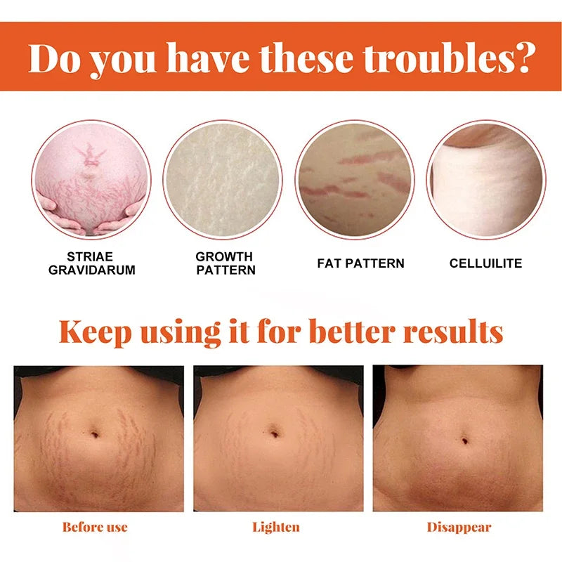 Stretch Marks Removal Cream – Anti-Aging & Skin Firming Body Treatment