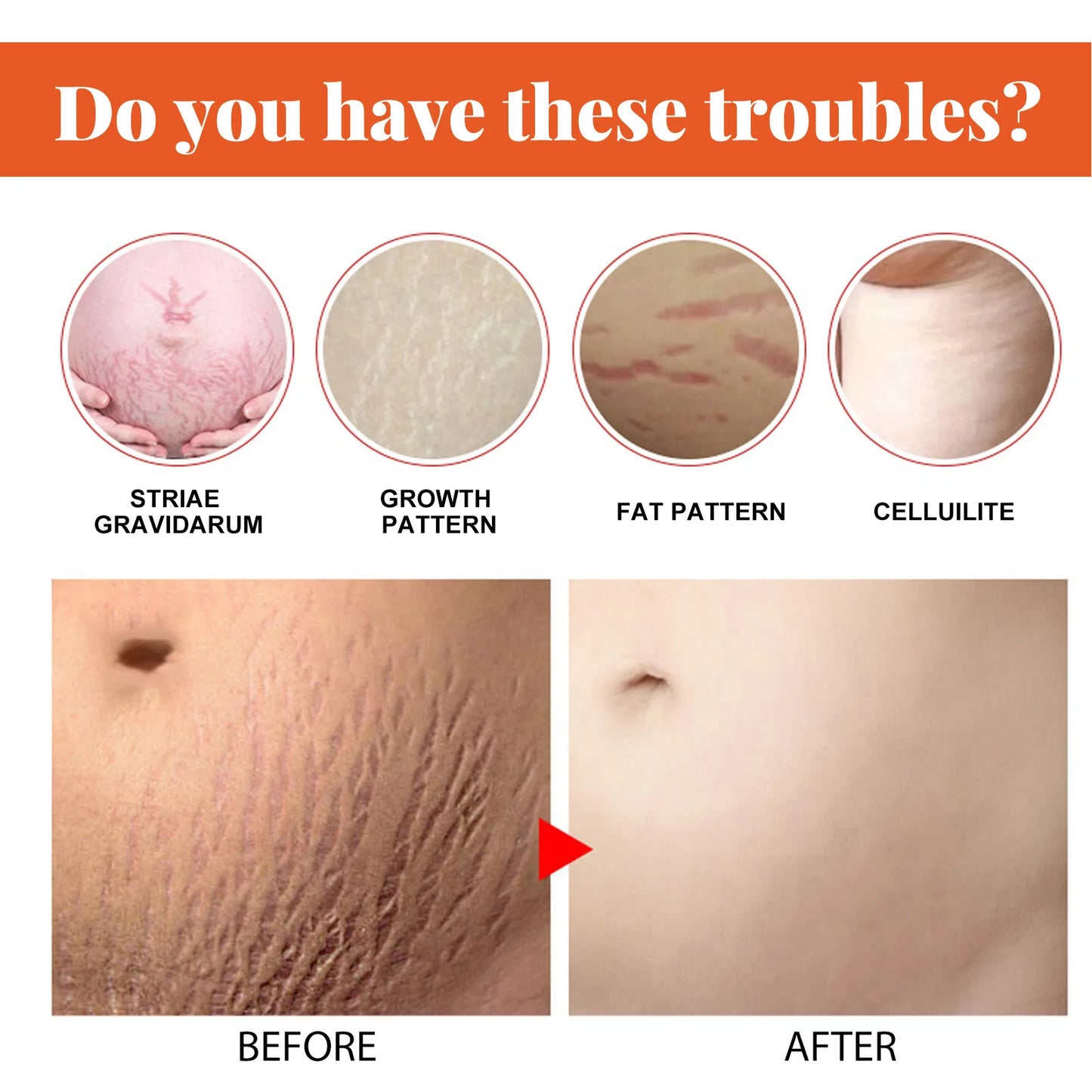 Stretch Marks Removal Cream – Anti-Aging & Skin Firming Body Treatment