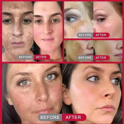 Whitening Freckle Serum – Correct Dark Spots, Brighten Skin, and Hydrate Deeply