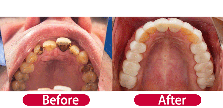 V34 Purple Whitening Toothpaste – Color Correcting Enzyme Mousse for Stains & Yellow Teeth (50g)