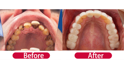 V34 Purple Whitening Toothpaste – Color Correcting Enzyme Mousse for Stains & Yellow Teeth (50g)