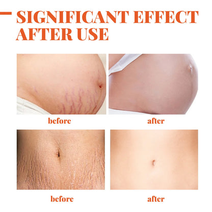 Stretch Marks Removal Cream – Anti-Aging & Skin Firming Body Treatment