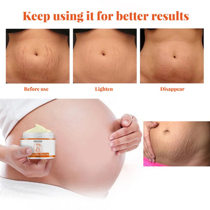 Stretch Marks Removal Cream – Anti-Aging & Skin Firming Body Treatment