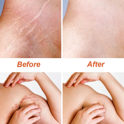 Stretch Marks Removal Cream – Anti-Aging & Skin Firming Body Treatment