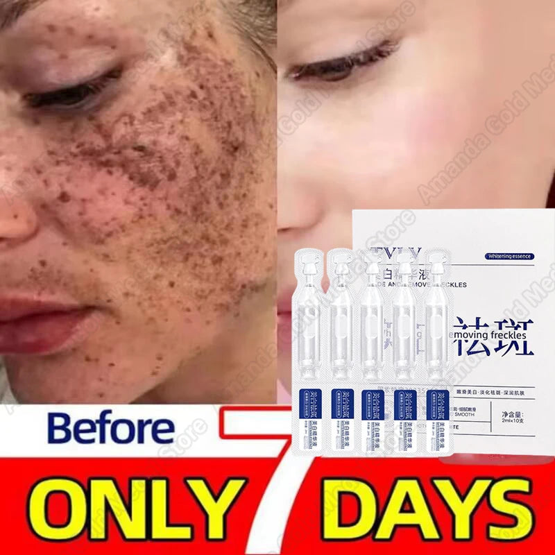 Whitening Freckle Serum – Correct Dark Spots, Brighten Skin, and Hydrate Deeply