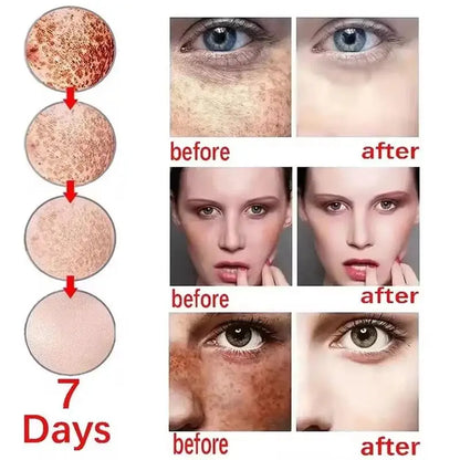 Whitening Freckle Serum – Correct Dark Spots, Brighten Skin, and Hydrate Deeply