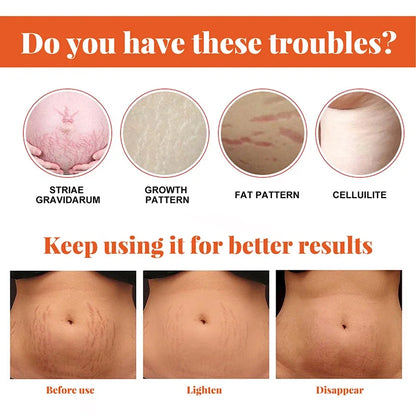 Stretch Marks Removal Cream – Anti-Aging & Skin Firming Body Treatment