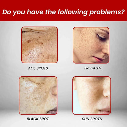 Whitening Freckle Serum – Correct Dark Spots, Brighten Skin, and Hydrate Deeply